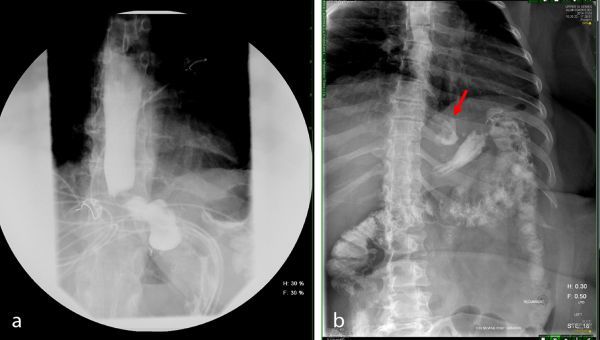 Upper GI series with water-soluble contrast showing early and delayed images evaluating for anastomotic leak