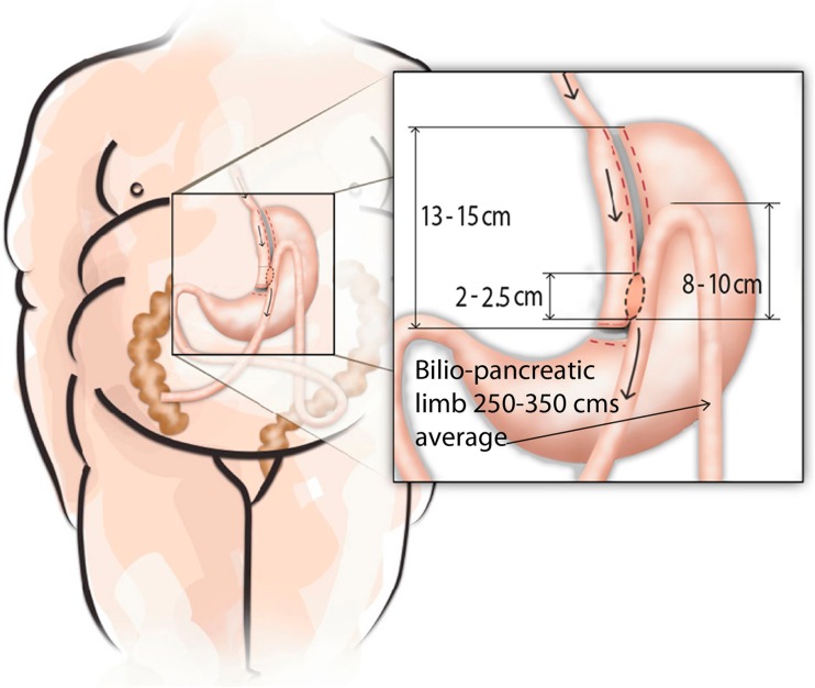 Anatomical diagram of one anastomosis gastric bypass showing the long tubular gastric pouch and loop gastrojejunostomy