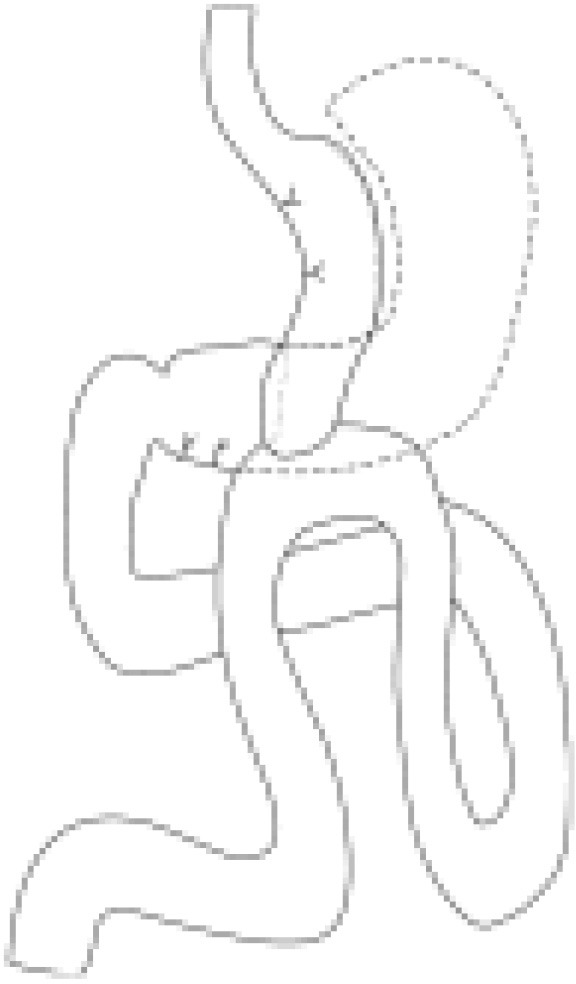 Upper GI fluoroscopy showing postoperative anatomy after one anastomosis gastric bypass with contrast in the tubular gastric pouch