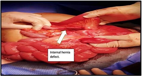 Diagram illustrating Petersen's space and the jejunojejunostomy mesenteric defect after Roux-en-Y gastric bypass