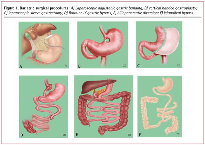Comparison of six bariatric surgical procedures showing gastric banding, vertical banded gastroplasty, sleeve gastrectomy, Roux-en-Y gastric bypass, biliopancreatic diversion, and jejunoileal bypass