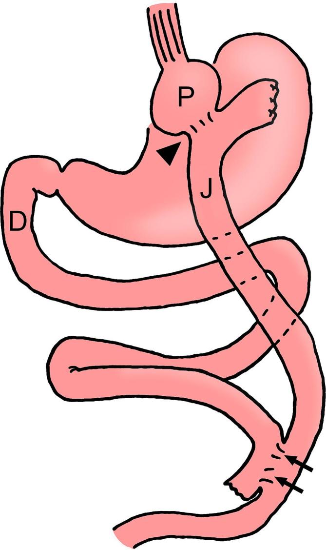 Anatomical diagram of Roux-en-Y gastric bypass showing the small gastric pouch, Roux limb, biliopancreatic limb, and common channel