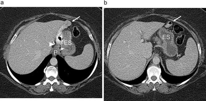 CT scan showing normal postoperative anatomy after Roux-en-Y gastric bypass