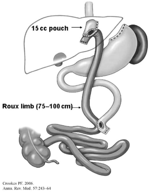 Diagram showing hormonal changes after Roux-en-Y gastric bypass including altered gut hormone secretion patterns