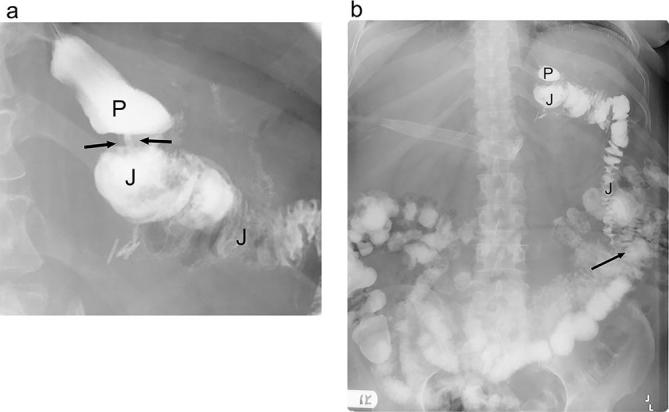 Upper GI series showing expected postoperative anatomy after Roux-en-Y gastric bypass with contrast filling the gastric pouch and Roux limb