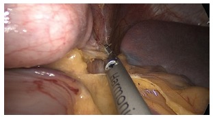 Intraoperative photograph showing dissection of the short gastric vessels and fundus during laparoscopic sleeve gastrectomy