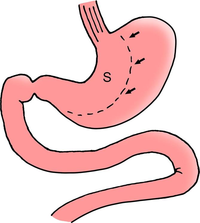 Anatomical diagram of sleeve gastrectomy showing the tubular gastric remnant and resected fundus