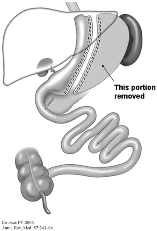Diagram showing hormonal changes after sleeve gastrectomy including ghrelin reduction and GLP-1 changes