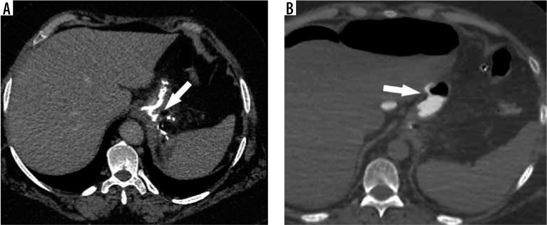 CT scan showing staple-line leak after sleeve gastrectomy with extraluminal fluid collection near the gastroesophageal junction