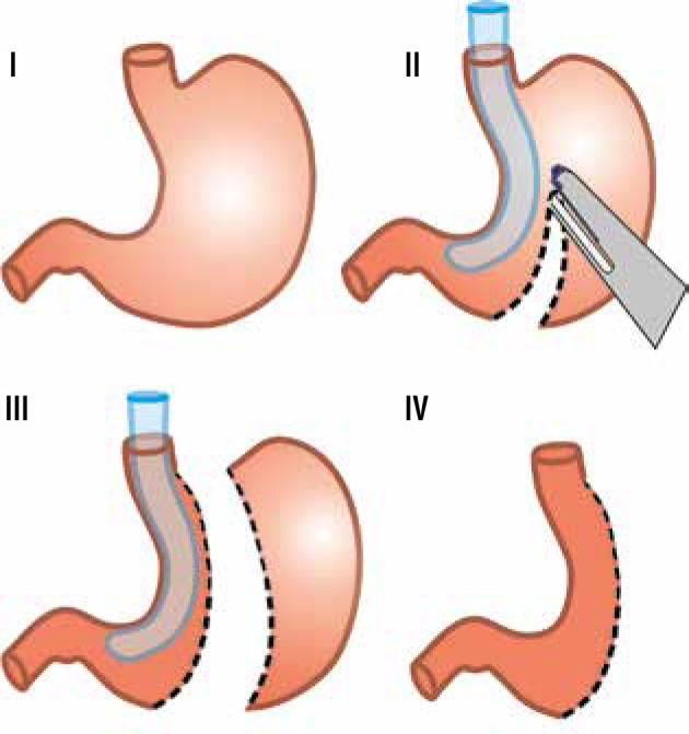 Schematic diagram showing the sleeve gastrectomy procedure with key anatomical landmarks and resection margins
