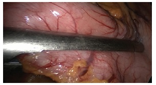 Intraoperative photograph showing stapler positioning during laparoscopic sleeve gastrectomy