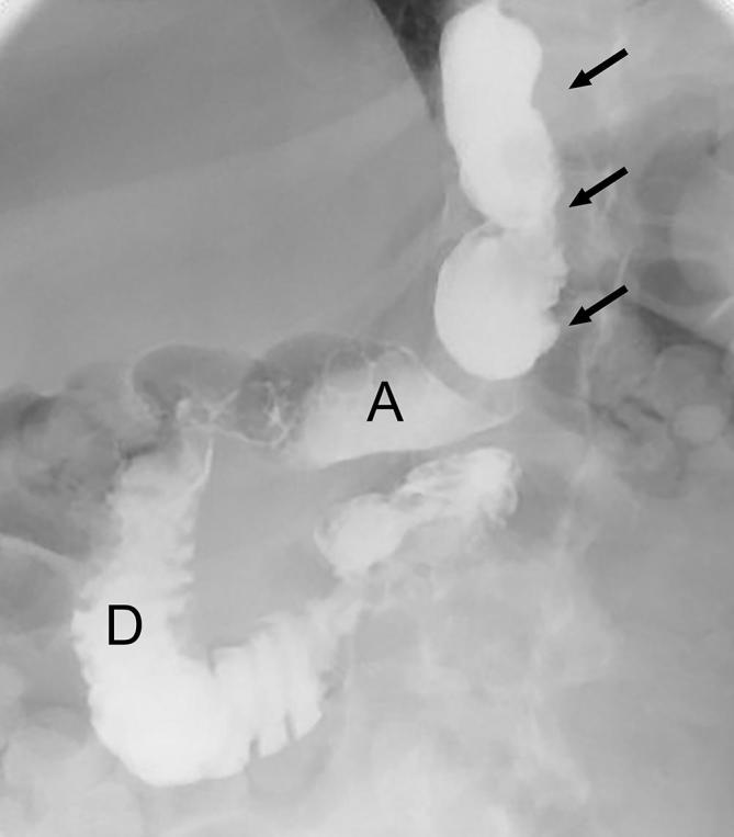 Upper GI series showing the narrow tubular sleeve after laparoscopic sleeve gastrectomy with contrast passing through the calibrated sleeve