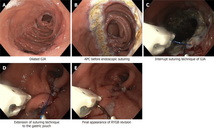 Endoscopic view of transoral outlet reduction procedure showing dilated gastrojejunal anastomosis and suturing technique