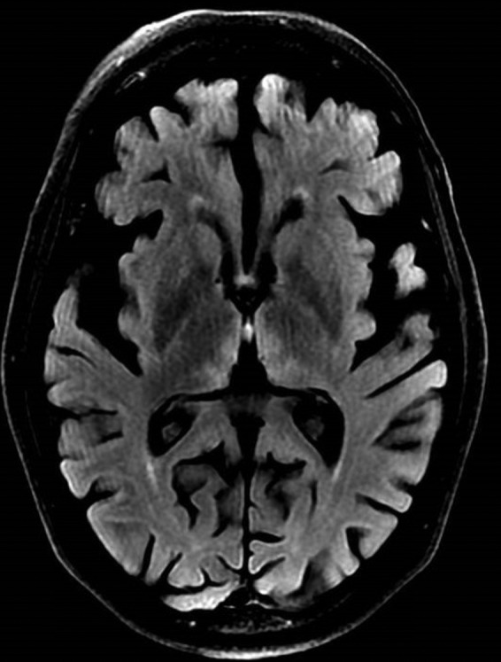 MRI brain showing T2 FLAIR hyperintensity in the mammillary bodies and periaqueductal gray matter characteristic of Wernicke encephalopathy