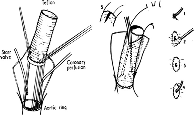 Surgical diagram of the classic Bentall composite valve-graft replacement of the aortic root