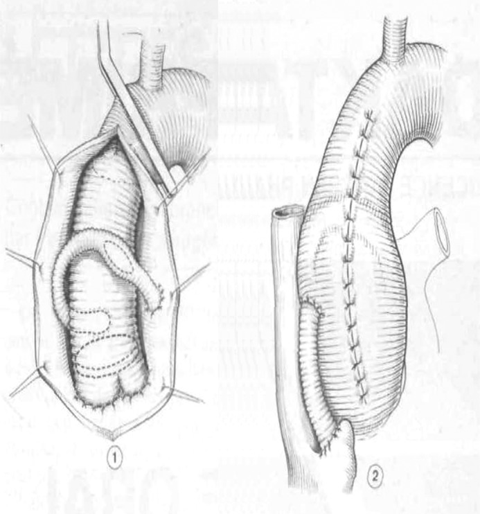 Surgical diagram of the Cabrol modification of aortic root replacement using interposition grafts to coronary arteries