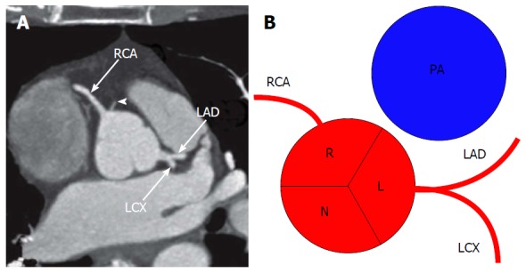 Diagram showing conventional origin of coronary arteries from the aortic sinuses of Valsalva