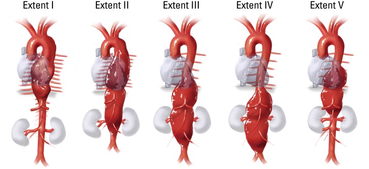 Schematic diagram of the modified Crawford classification for thoracoabdominal aortic aneurysm extents I through V