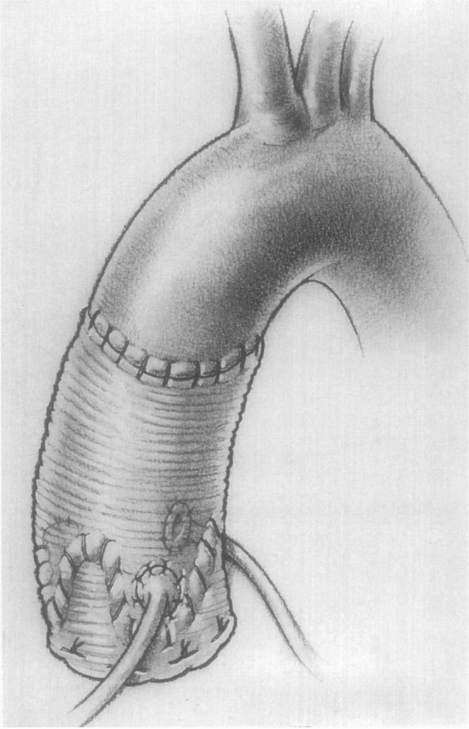Surgical diagram of the David valve reimplantation procedure for aortic root replacement
