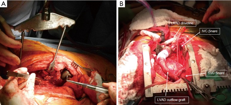 Surgical illustration of the bicaval heart transplant technique showing left atrial, IVC, SVC, PA, and aortic anastomoses
