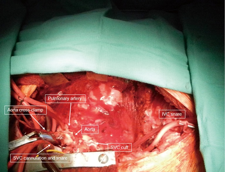 Surgical photograph showing the donor heart placed into the recipient chest during orthotopic heart transplantation