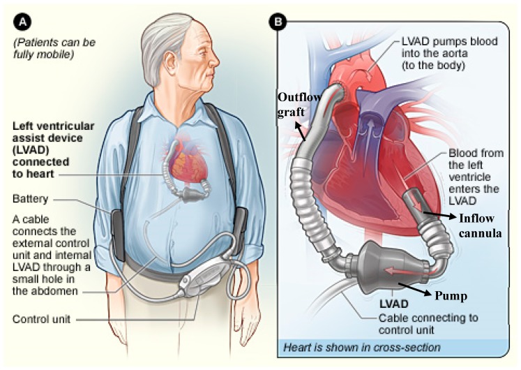 Diagram of LVAD system showing internal pump with inflow cannula in LV apex, outflow graft to ascending aorta, percutaneous driveline, external controller and batteries