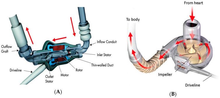 Comparison of axial-flow pump (HeartMate II) and centrifugal-flow pump (HeartWare) designs showing impeller mechanisms