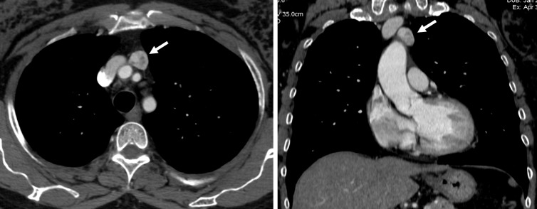 CT imaging of a mature teratoma in the anterior mediastinum showing fat, calcification, and soft tissue components
