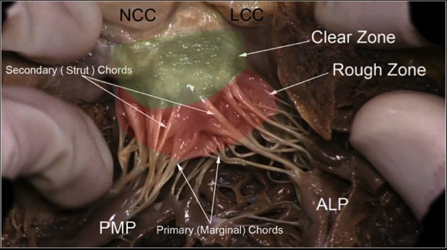 Anatomical specimen showing mitral valve leaflet regions and chordae tendineae