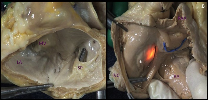Comparative anatomy of the atrial septal surfaces showing the mitral and tricuspid valve regions