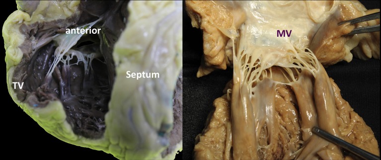 Comparison of papillary muscle anatomy in mitral and tricuspid valves