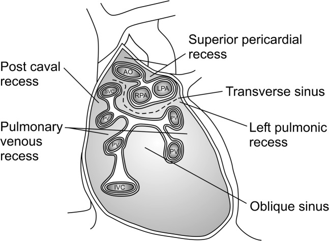 Line diagram of the posterior pericardial reflections showing the transverse and oblique sinuses