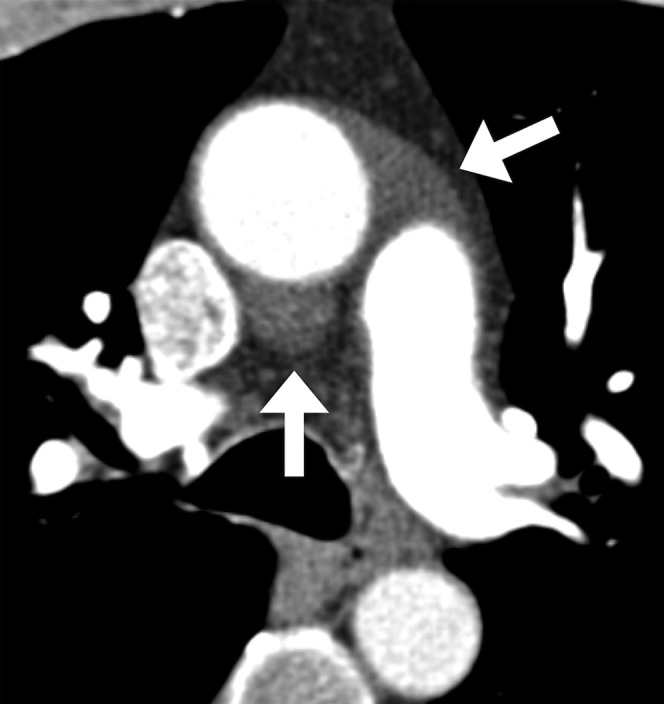 CT imaging demonstrating pericardial recesses including the transverse sinus, oblique sinus, and superior pericardial recess