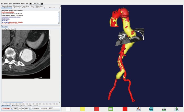 3D CTA reconstruction of an extent II thoracoabdominal aortic aneurysm with chronic dissection