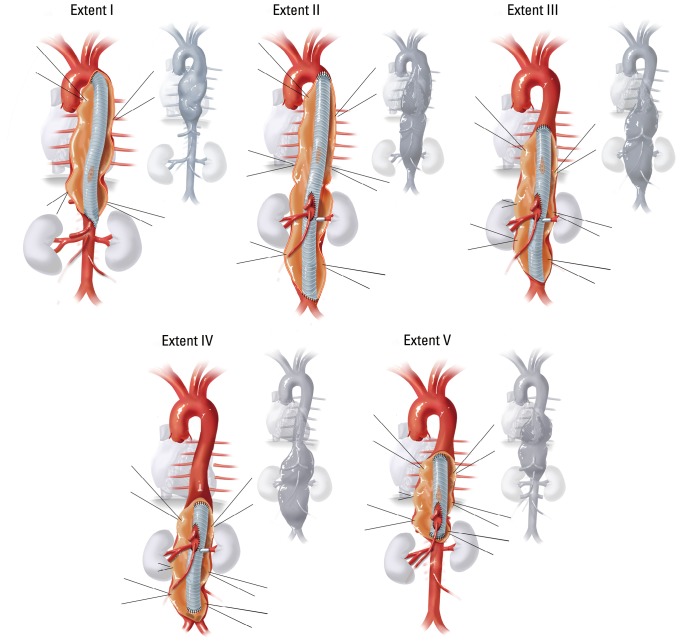 Schematic diagrams of open surgical repair techniques for thoracoabdominal aortic aneurysm extents I-V