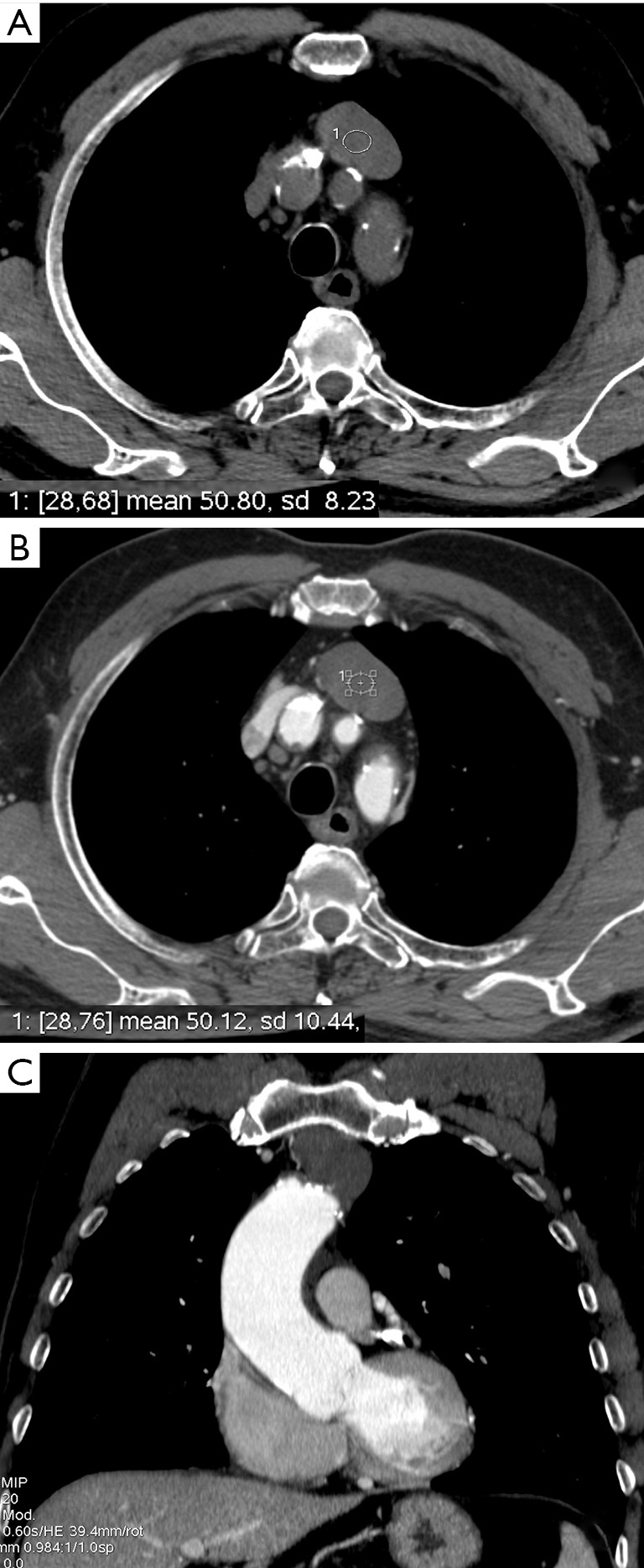 CT scan of the chest showing a thymoma in the anterior mediastinum with characteristic calcification pattern