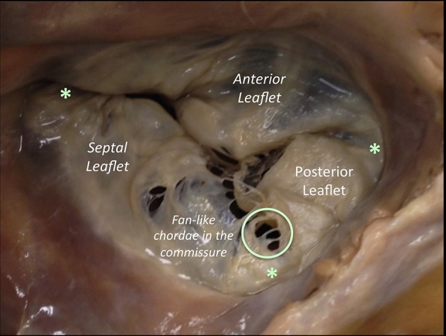 Anatomical specimen of the tricuspid valve showing the three leaflets and their attachments