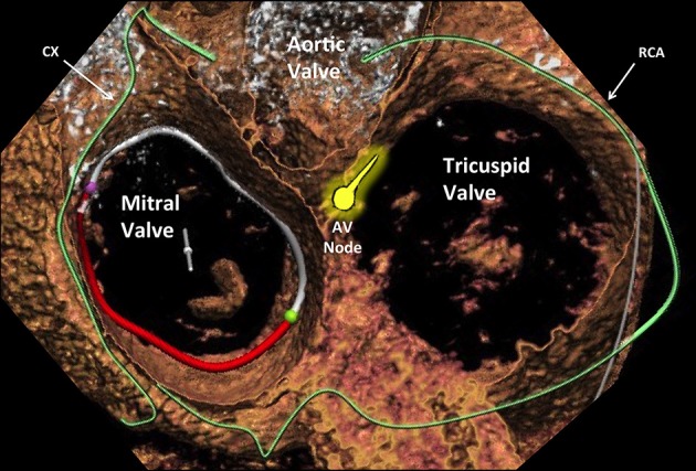 Cross-sectional view of all four cardiac valves showing their spatial relationships and proximity to coronary arteries