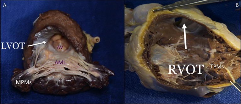 Anatomical specimen showing the ventricular outflow tracts and interventricular septum