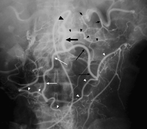 Angiographic image demonstrating the arc of Riolan connecting SMA and IMA territories