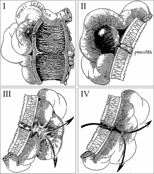 Diagram showing the classification stages of diverticular disease from mild inflammation to peritonitis