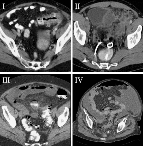 CT scan images showing the four stages of diverticulitis from pericolic inflammation to fecal peritonitis