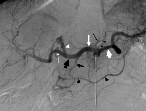 IMA arteriogram showing the inferior mesenteric artery and its branches supplying the left colon