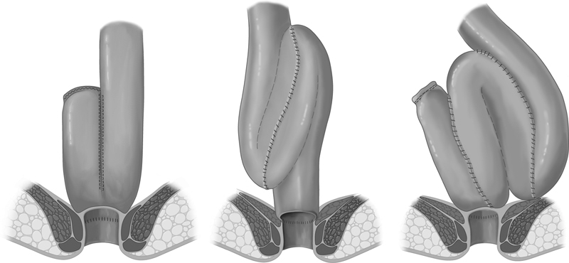 Diagram showing different ileal pouch configurations including J-pouch, S-pouch, and W-pouch designs