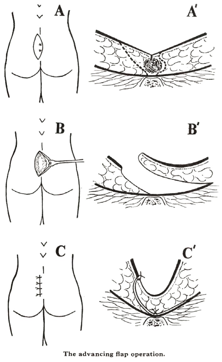 Diagram of the Karydakis off-midline closure technique for pilonidal disease