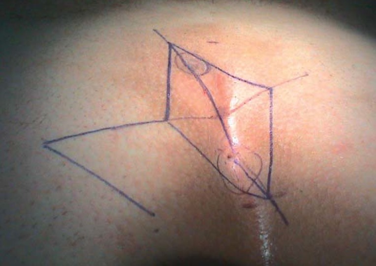 Diagram of the modified Limberg rhomboid flap technique for pilonidal disease