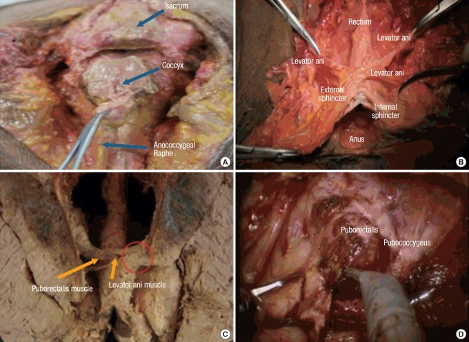 Diagram of the pelvic floor musculature including the levator ani and puborectalis