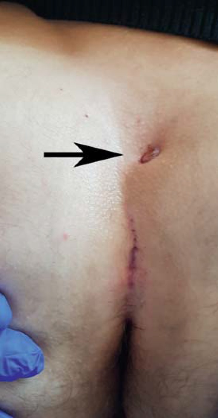 Clinical photograph showing chronic pilonidal disease with midline pits in the natal cleft