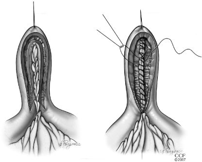 Diagram of the Finney strictureplasty technique for intermediate-length strictures