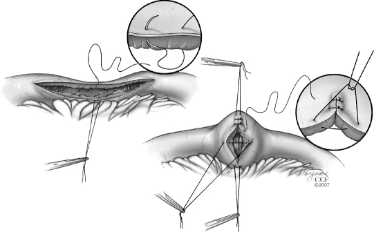 Diagram of the Heineke-Mikulicz strictureplasty technique showing longitudinal incision and transverse closure